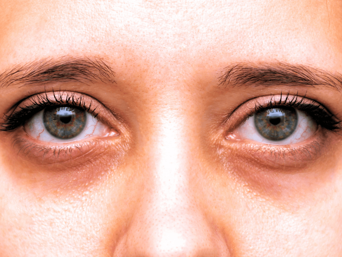 Why Allergies Might Be Causing Your Dark Under-Eye&nbsp;Circles